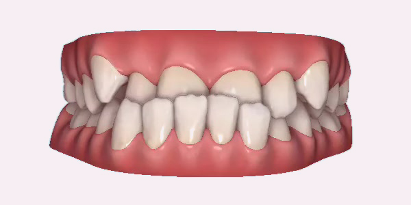 Underbite